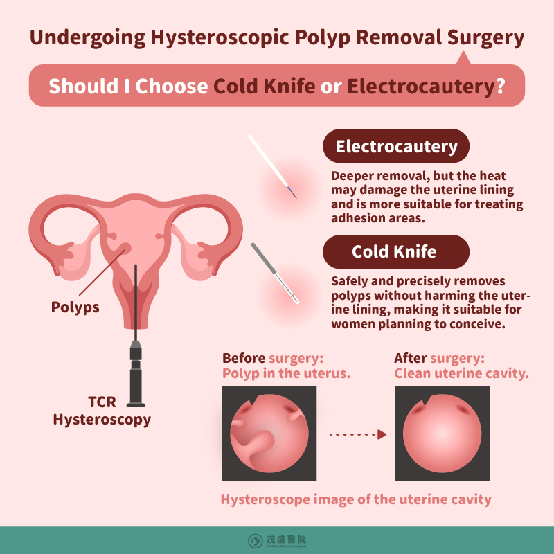 Undergoing Hysteroscopic Polyp Removal Surgery
